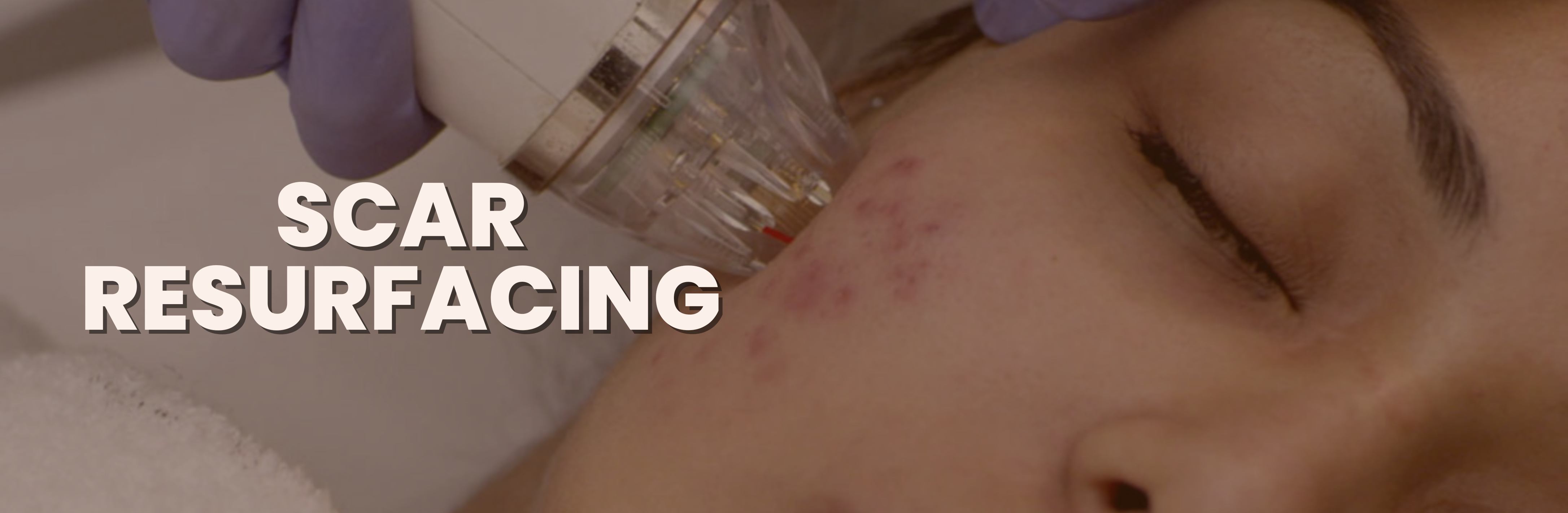 Skin Scar Resurfacing