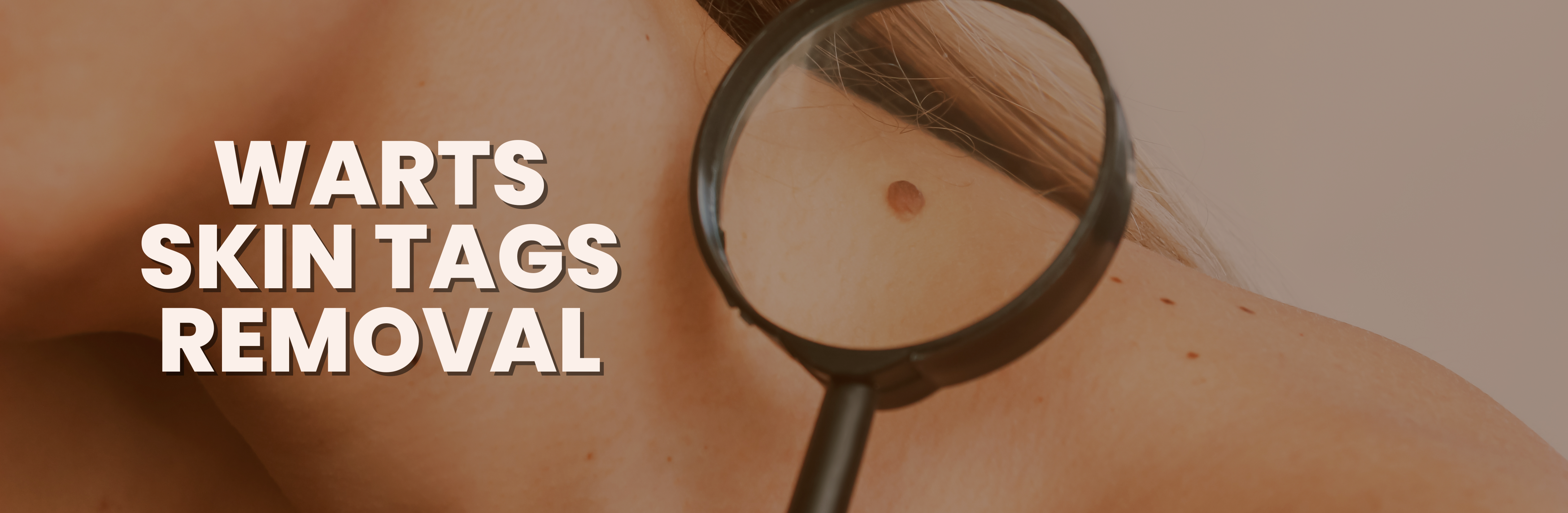 Skin tag removal